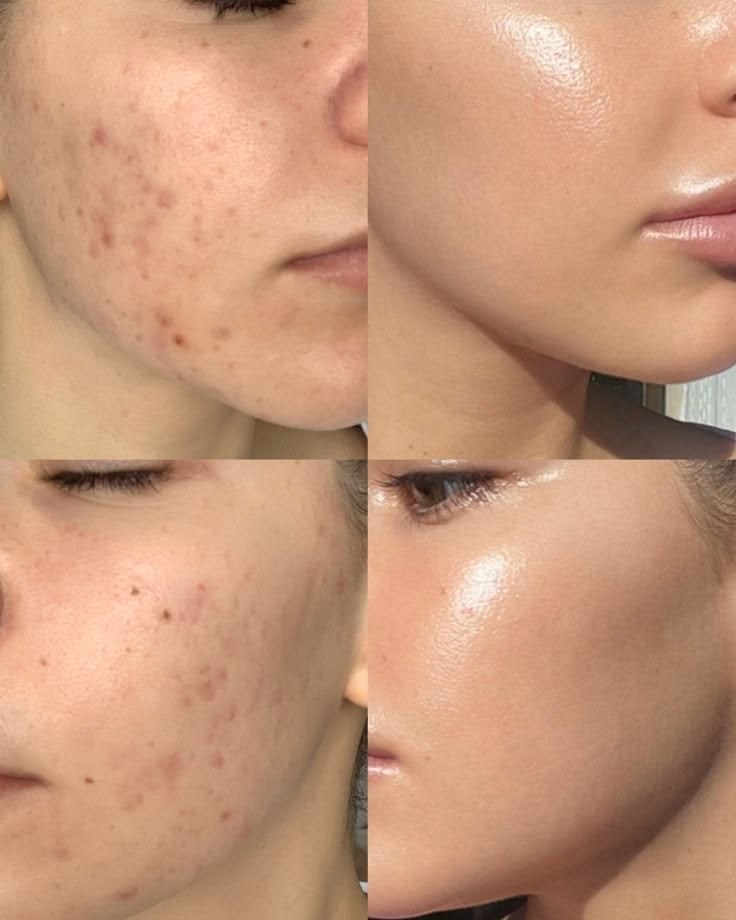 Before and after using the Arbutin 7.0 + TXA 4.0 Brightening Cream